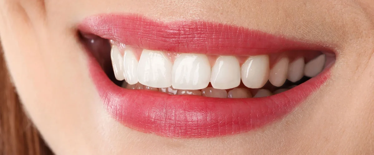 sonrisa despues