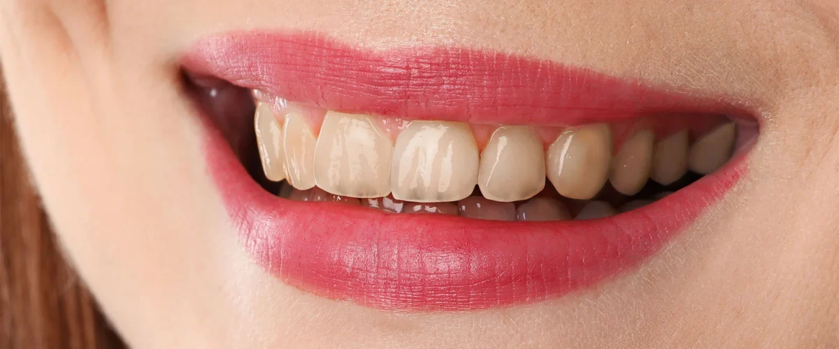 sonrisa antes
