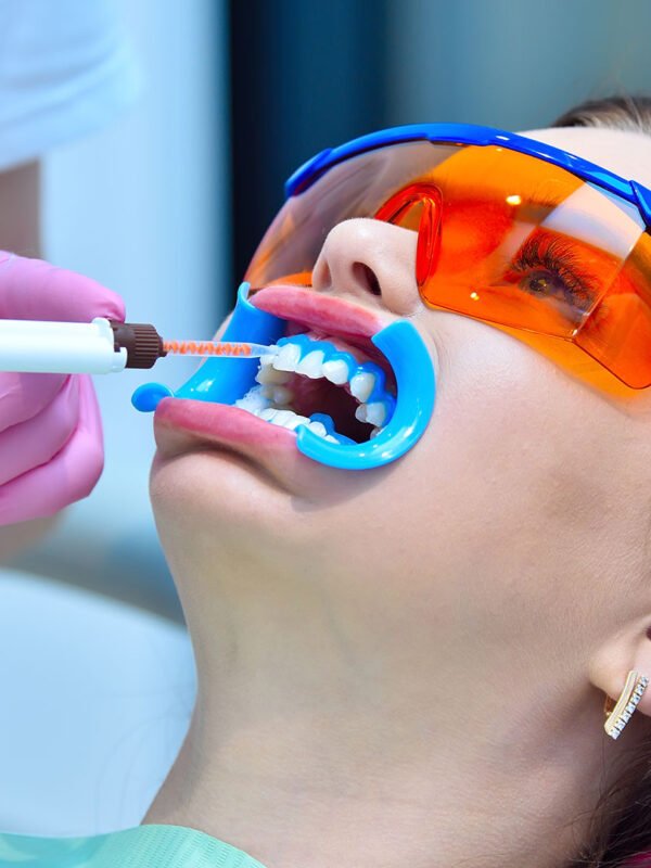 blanqueamiento dental