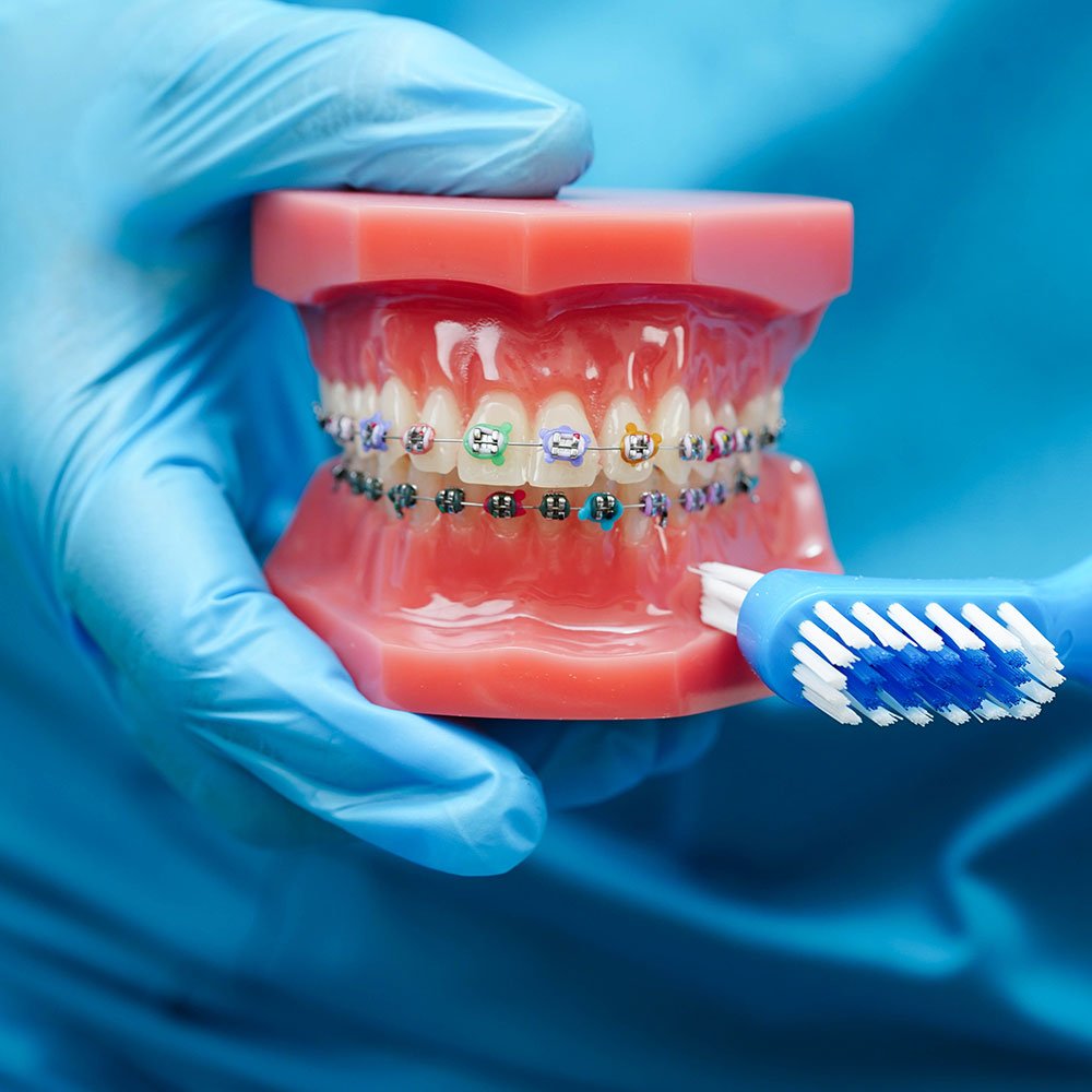 tipodont con brackets