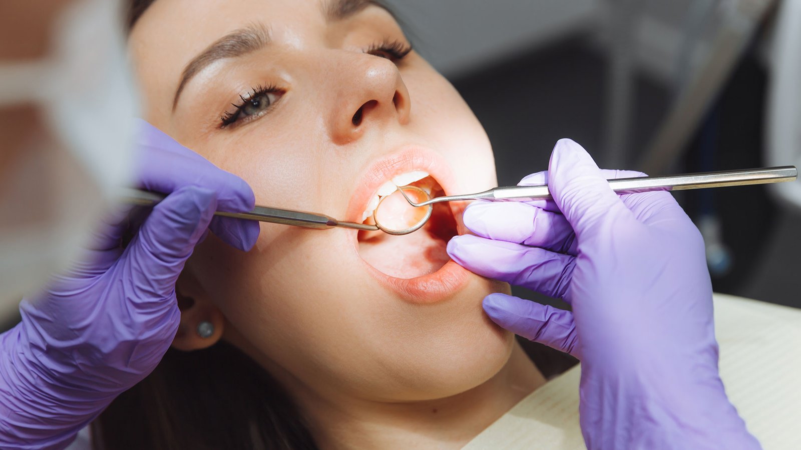 extracción de tercermolar molar o muelas del juicio