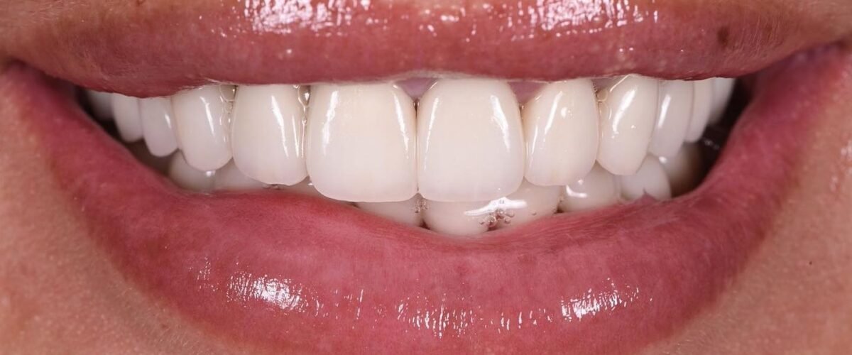 caso dental despues