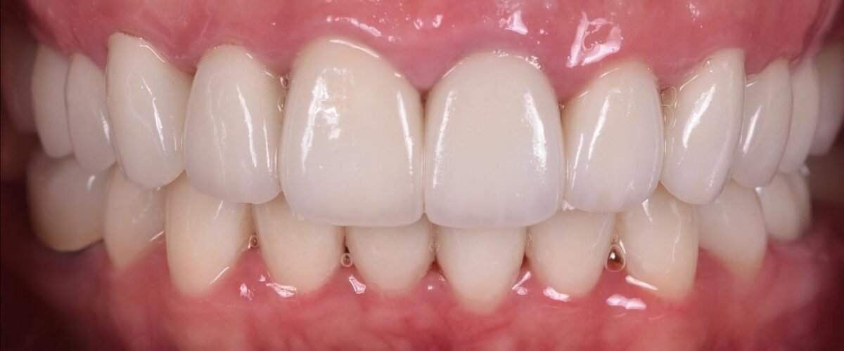 caso dental despues