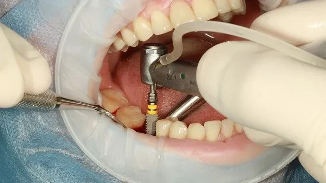 operando-implantes-dentales
